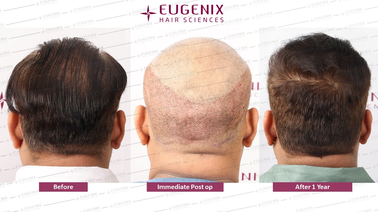 https://cdn.forumhairtransplant.com/original/3X/f/5/f599e2168dcc3567cc37d82b38753d5be86d802e.jpeg