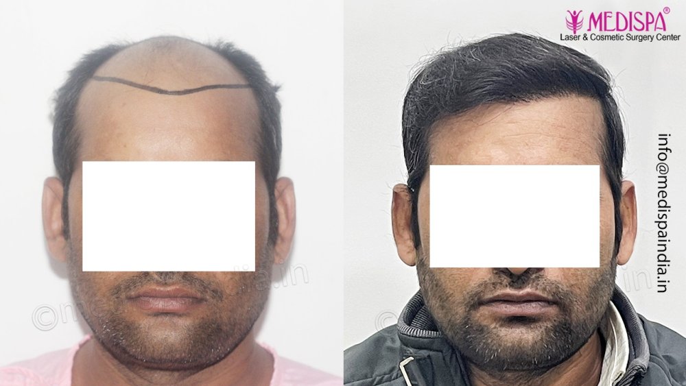 Dr. Suneet Soni - 4992 Grafts | 12-Month Result | Combination FUT + FUE + Beard photo