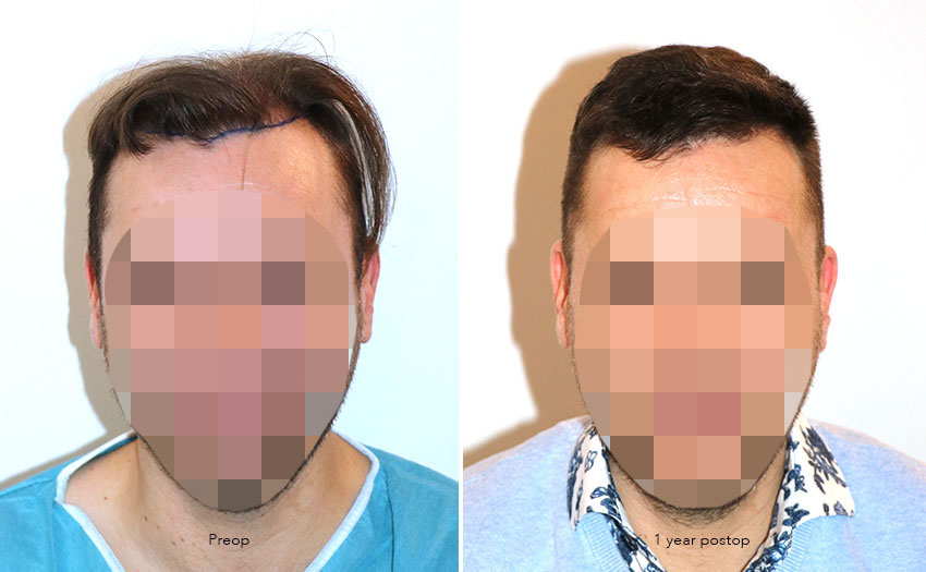 Case performed by Dr. Feriduni – 4008 FU in 1 procedure photo