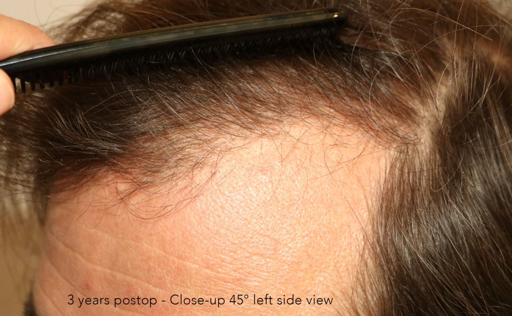 Case performed by Dr. Feriduni – 3378 FU in 1 procedure photo