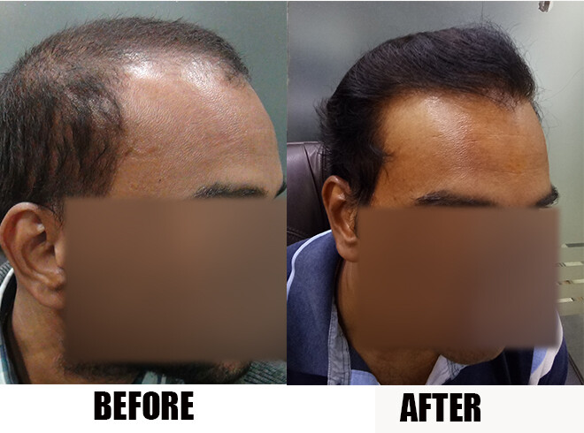 RA 140 - (5547FUSE/Fue grafts) 1 year 3 months update photo