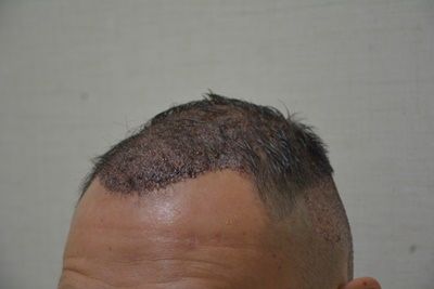 DR HAKAN DOGANAY/4055 GRAFTS/FUE+Implanter Pen photo