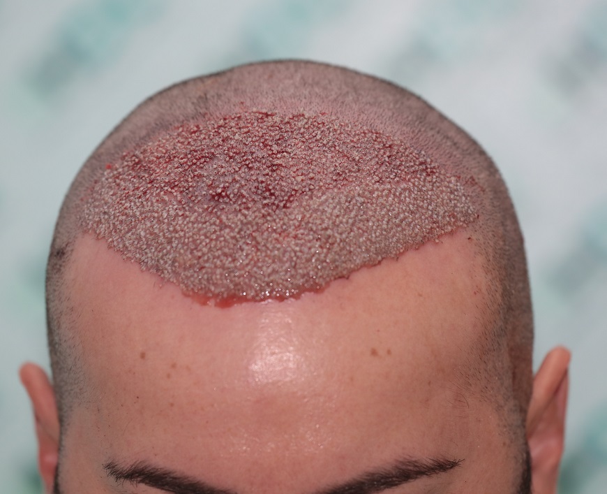 Result of NW3 patient after 3230 grafts after 7 months – HDC Hair Clinic – Dr Christina photo